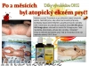 Přírodní bylinné výrobky na atopický ekzém Alfa + Omega+