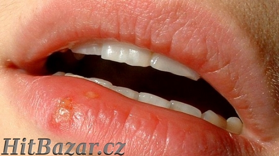 Zbavte se bleskově OPARU!