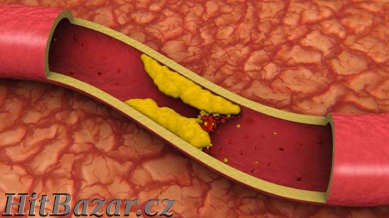 Vysoký CHOLESTEROL?